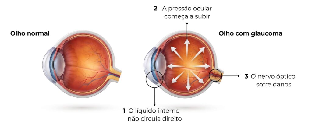 glaucoma-1024x414 glaucoma